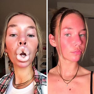 Filler Dissolving Is Melting People's Faces! #CosmeticTreatment #FaceFillers #DarkBeauty | James Welsh