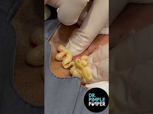 Chest Steatocystoma Surprise!