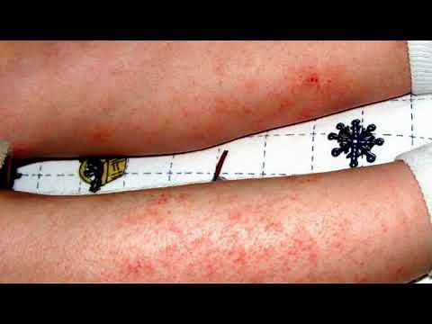 Can You Use Mupirocin Ointment For Eczema