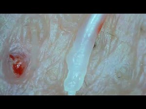 0486 pull out hair around the chin