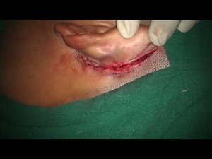 3-Steps-technique to close Postauricular incision after any Ear surgery || Basic Suturing technique