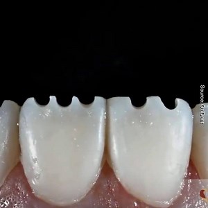 How to get the perfect smile! 😍😁😁 via Ozident | Inventions & Creations