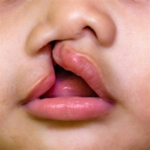 Cleft Lip and Cleft Palate are congenital deformities that occur when a baby’s lip or mouth does not form properly during early pregnancy. They can occur individually or together. 1. Definitions: Cleft Lip: A split or opening in the upper lip. It can be: Unilateral (one side) Bilateral (both sides) Complete (extends into the nose) Incomplete (partial split) Cleft Palate: An opening in the roof of the mouth (palate), which may involve: Hard palate (bony front portion) Soft palate (muscular back p