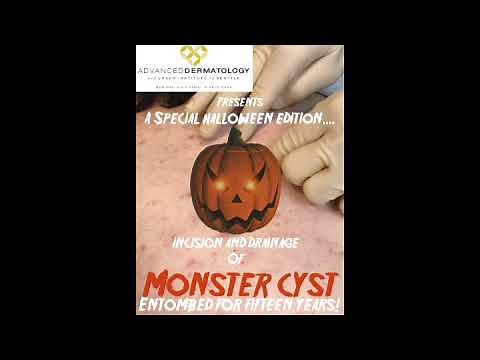 Epidermoid Cyst Extraction | Dr. Steven Greene in Seattle