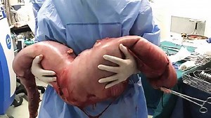 Constipated Man Has 28 Pounds of Feces Surgically Removed