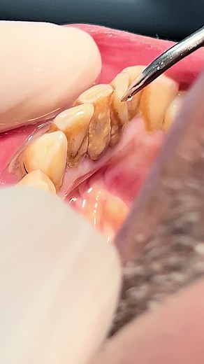 Cleaning and Scaling calculus & tartar at the Dentist
