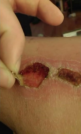 scab removal