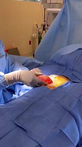 Silicone implant removal and capsulectomy