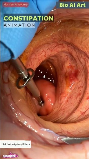Fecal Impaction Blocks Colon Lumen Animation | Digestive System | Human Anatomy | Bio AI Art | 34