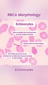 Normal and abnormal RBC shapes in blood smear Learn fast with MED LAB ZONE #rbcmorphology #hematology #bloodsmear | MED LAB ZONE