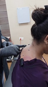 chiropractors can be effective in addressing neck humps (Dowager's hump) by focusing on spinal alignment and muscle imbalances. Chiropractors use various techniques like spinal adjustments, massage, and exercises to improve posture and reduce the hump's prominence. How Chiropractors Help with Neck Humps: Spinal Adjustments: Chiropractors use gentle, targeted adjustments to realign the cervical spine, which can help reduce the severity of a forward head posture and diminish the hump. Flexion-Dist