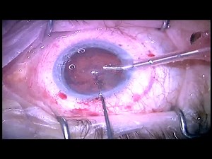 Femtosecond Cataract Extraction After Flap Amputation - Eyetube