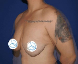 FTM "top" surgery Before & After Morph Video