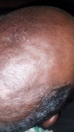 #hairloss #hairproblm #adivasi #besthairlosstreatment #adivasi #hairpatching #hairchallega #hairpainting #hairchallega #jamalgotatreatment #besthairlosstreatment #adivasi | Mohd Shad Raza