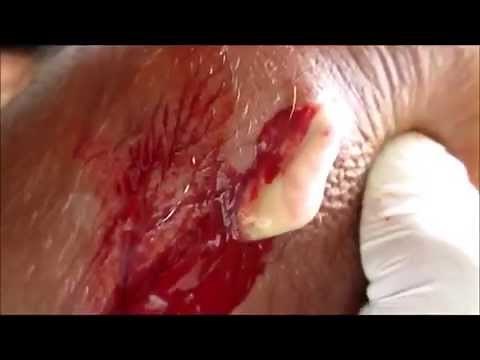 Carbuncle & Infected Monkey Bite