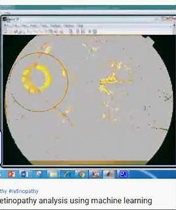 Diabetic retinopathy analysis using machine learning DREAM -MATLAB RESEARCH PROJECT