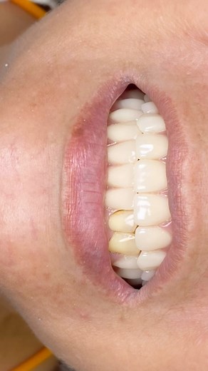 Replacement of missing tooth before it is too late.✨ Pateint complain of old denture was dirty and loose. Hence, is the time to change a new one. After several discussions with patient, we had decided to do an acrylic denture for patient. Multiple options for tooth replacements : - implant - bridges - acrylic denture - flexible denture (valplast) - others Discuss with our dentists to know more about that! #smileedental #pantaidalamdentalclinic #dentalclinicnearme #bangsarsouthdentalclinic #denti