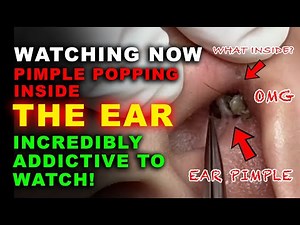 Pimple Popping Inside the Ear – Incredibly Addictive to Watch!