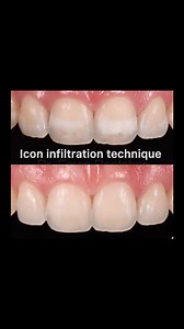 Icon infiltration technique # | Dr. Eman Bentaher
