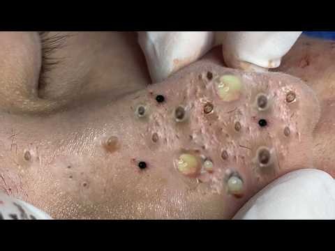 Most Satisfying Pimple Popping Compilation Ever 🔥