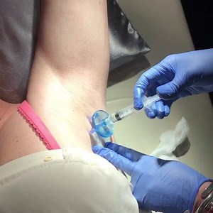 This five minute treatment will stop excessive sweating for 6-9 months! #hyperhydrosis #botoxforsweating | Vitality Anti Aging Center