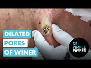 Two HUGE Dilated Pores of Winer!!