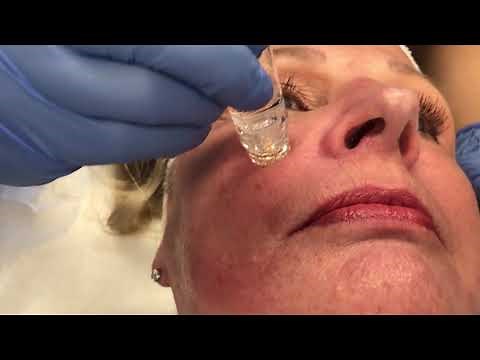 The YPS Gold FillTox Facial! - Dr. Anthony Youn