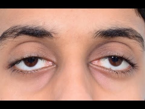 Examination of Acquired Myogenic Ptosis