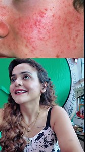 5.1K views · 27 reactions | Acne Care  9311788912 Add- CSC Market, Sec-18B, Dwarka, NewDelhi - 110078 #facetreatment #faceglow #facebrightening #skincare #viral | Nisha Lambha - Sparsh Beauty Care & Hair Treatment LLP | Facebook