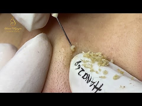 Loan Nguyen Acne Treatment (#114)