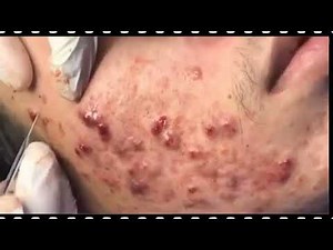 BIGGEST PIMPLE POPPING EXPLOSION BLACKHEAD REMOVAL 2020!!!