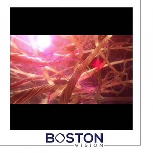 Laser floater treatment (LFT) is also known as Laser Vitreolysis. It is a non-invasive, painless outpatient treatment option for patients who experience persistent and bothersome floaters. The procedures takes 20-60 minutes. Floaters usually need two LFT sessions to have a significant reducation in size. At Boston Vision, we offer in house LFT using our YAG laser. #vision #floater #clinic #samedayprocess #brookline #doctors #optometry #ophthalmology | Boston Vision