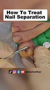 How To Treat Nail Separation: Onycholysis Recovery Steps | Miss Foot Fixer #nailsergery #missfootfixer #toenailremoval | Miss Foot Fixer