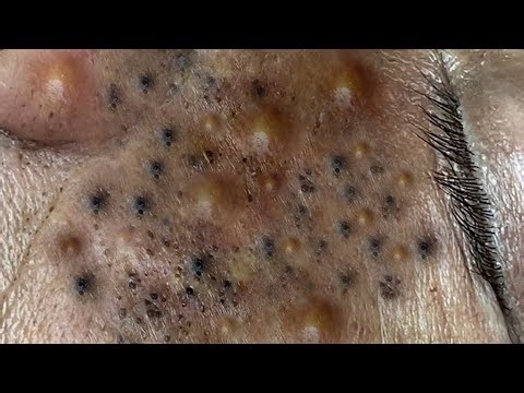 How to Remove Blackhead - Relax everyday with Win Spa Official