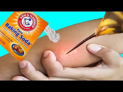 14 EFFECTIVE Home Remedies For Bee Stings | Natural Bee Sting Treatment