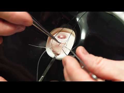 Simulated Surgery: Retinal Buckling: Placing the Sutures for a Scleral Buckle