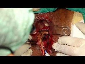 Fistulectomy Grade-IV Complex Transphincteric Fistula In Ano by Dr.Varughese Mathai