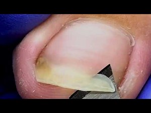 Pedicure Tutorial Trimming Of Slightly Yellowish And Darkened Long Nails