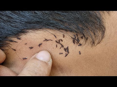 How to get rid of head lice fastly - Comb those big head lice at home
