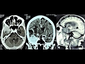 SPHENO ORBITAL TEMPORAL BASAL MENINGIOMA -MICROSURGERY-dr suresh dugani/HUBBALLI/KARNATAKA/INDIA