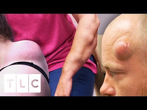 The Most Drastic Before & Afters | Dr Pimple Popper