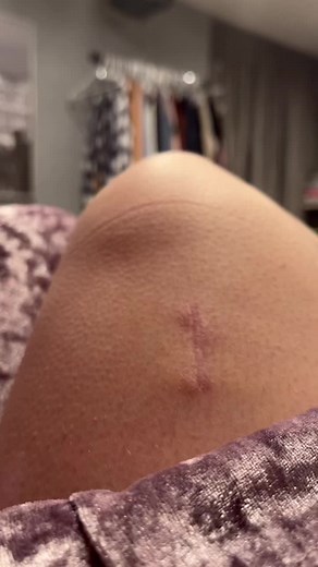Understanding Muscle Biopsies in Chronic Illness