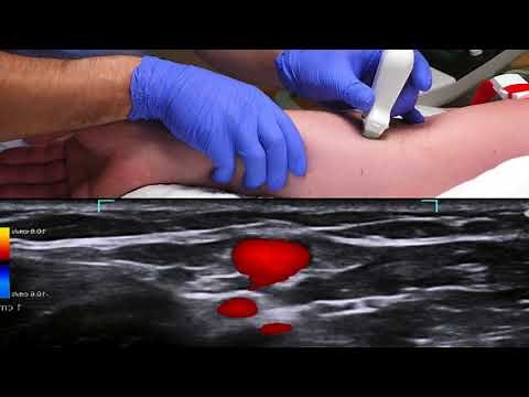Ultrasound-guided peripheral venous cannulation