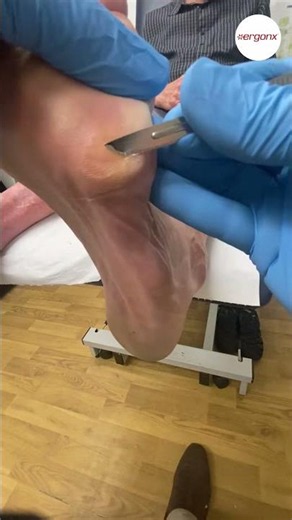 Say Goodbye to Foot Pain Watch This Corn Removal by a Podiatrist #FootCare #Podiatry