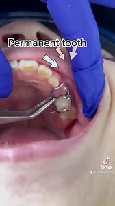 Space maintainer 醴✨ . . By • @drmassidentalclinic | Dentistry blog | Facebook