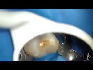 Endodoncia premolar superior