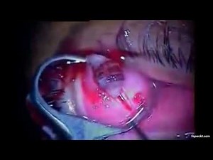 Bot fly removal from eye