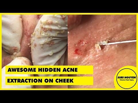 AWESOME HIDDEN ACNE | EXTRACTION ON CHEEK | PART 2