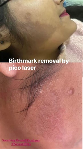29K views · 31 reactions | Birthmark removal by pico laser. Anamnagar kathmandu. Near bajeko sekuwa anamnagar. You can find the exact location on google maps also if you search for “kathmandu clinic of cosmetic surgery”. Or you may call 015707056 or 9860777206 for details. | KCCS Dermatology | Facebook