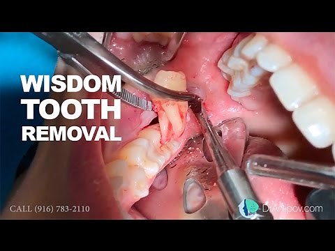 Wisdom tooth removal in 5 MIN or less. Surgical Guide: Online Course + Free e-Book!